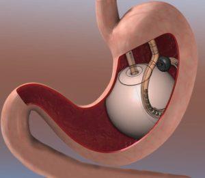 Intragastric Balloon