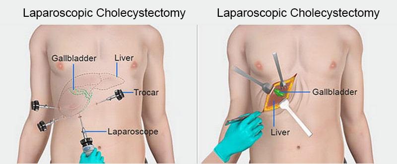 Laparoscopic Cholecystectomy