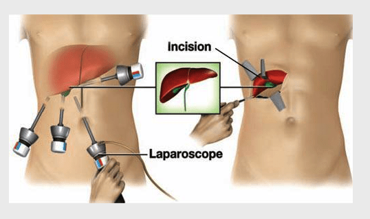 Laparoscopic Liver Surgery