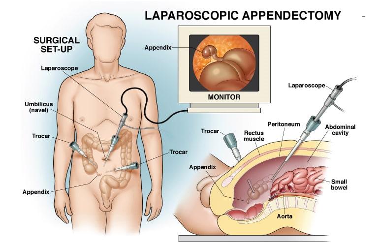 Laparoscopic-appendix-surgery