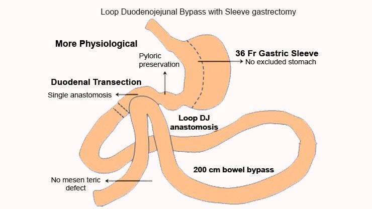 duodenal-jejunal-bypass