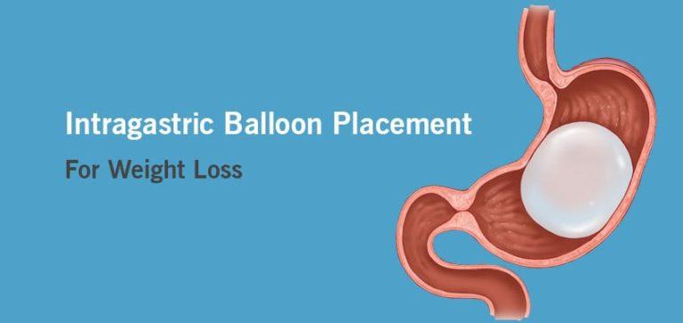 Weight Loss Surgery Center For Intragastric Balloon Surgery In Indore 9841