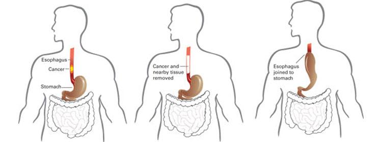 laparoscopic-cancer-treatment