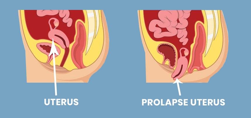 Laparoscopic_vault_prolapse