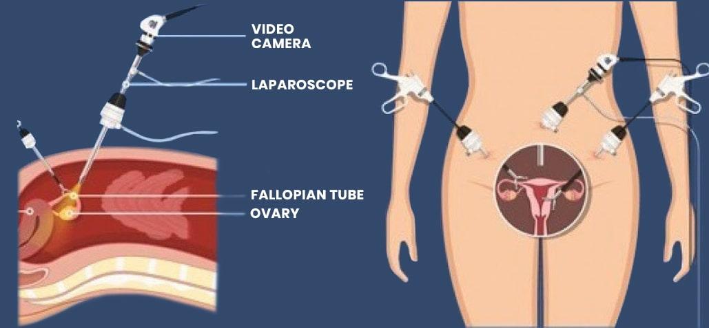 Total Laparoscopic Hysterectomy