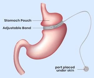 banded-gastric-bypass_surgery