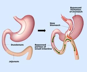 mini-gastric-bypass_surgery