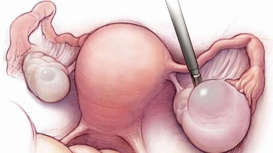 ovarian-cystectomy